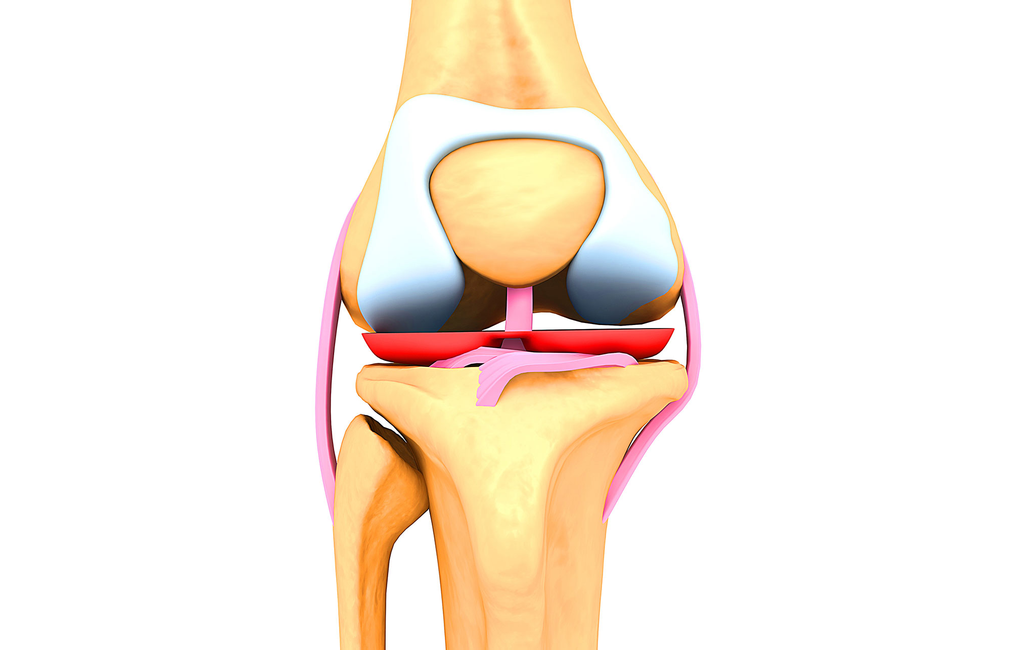 Artroplastia de rodilla