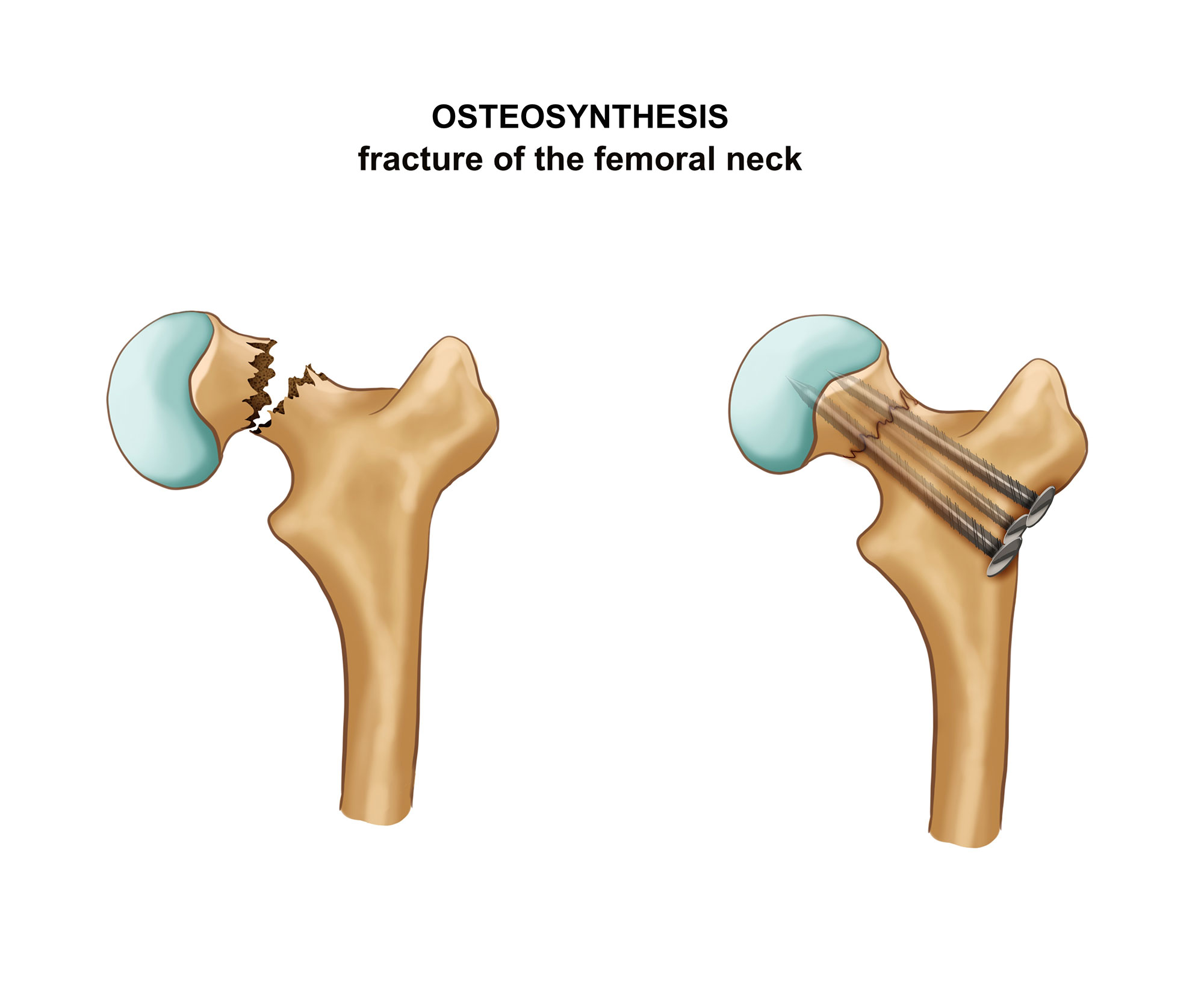 Osteosíntesis de cadera
