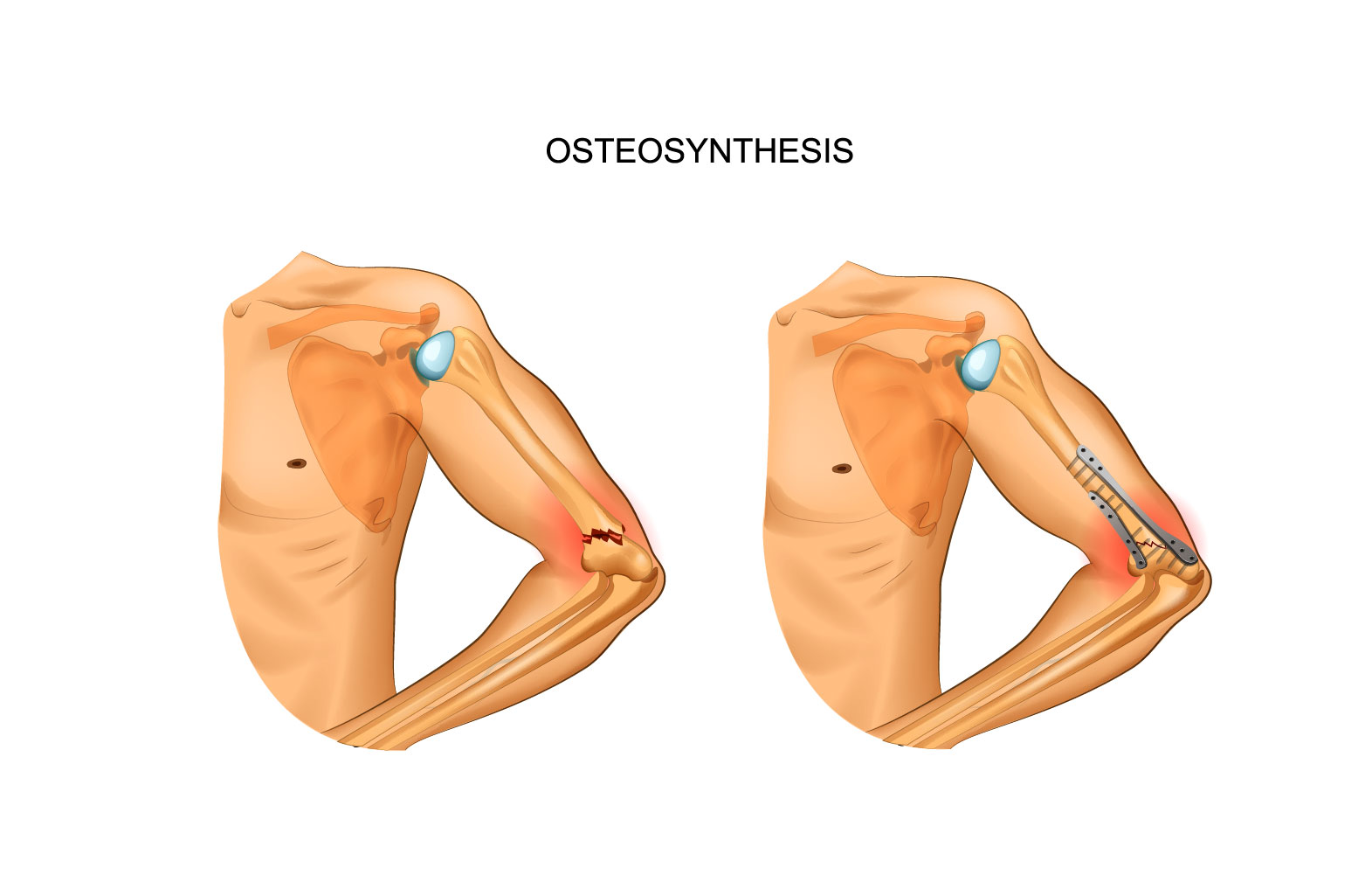 Osteosíntesis de fracturas